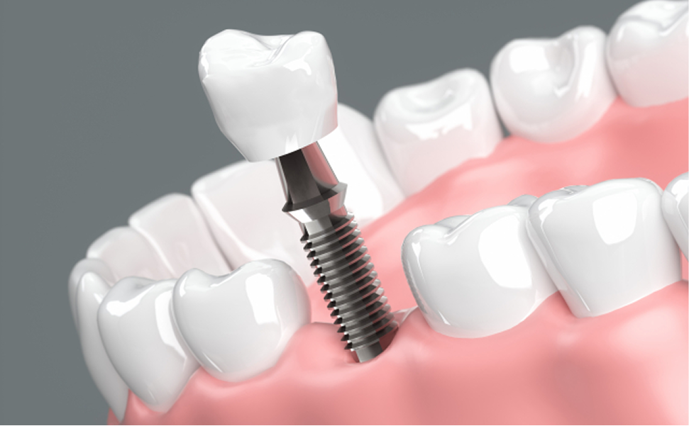 インプラント治療とは？