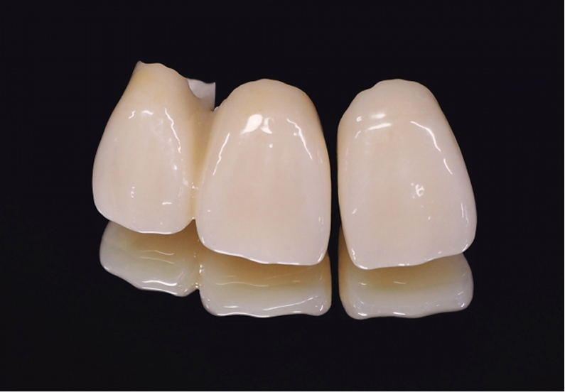 アバットメントの装着