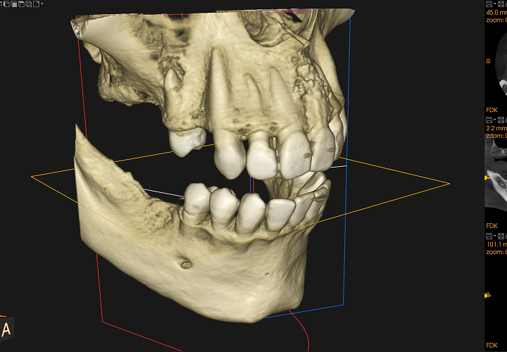 3Dコンピューターインプラントシステム