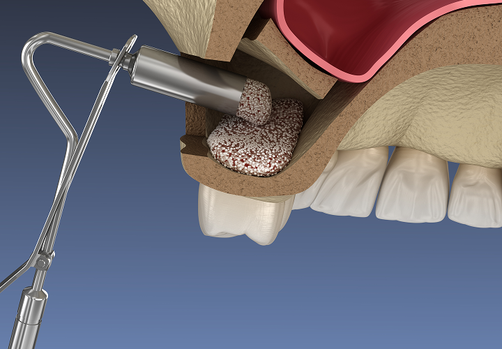 骨再生療法（サイナスリフト、ソケットリフト、GBR）
