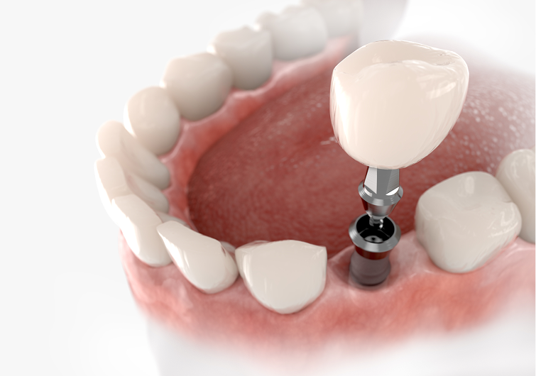 ストローマン社