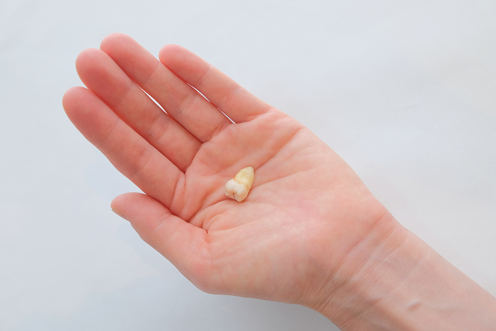 複数本を同時に抜歯することも可能