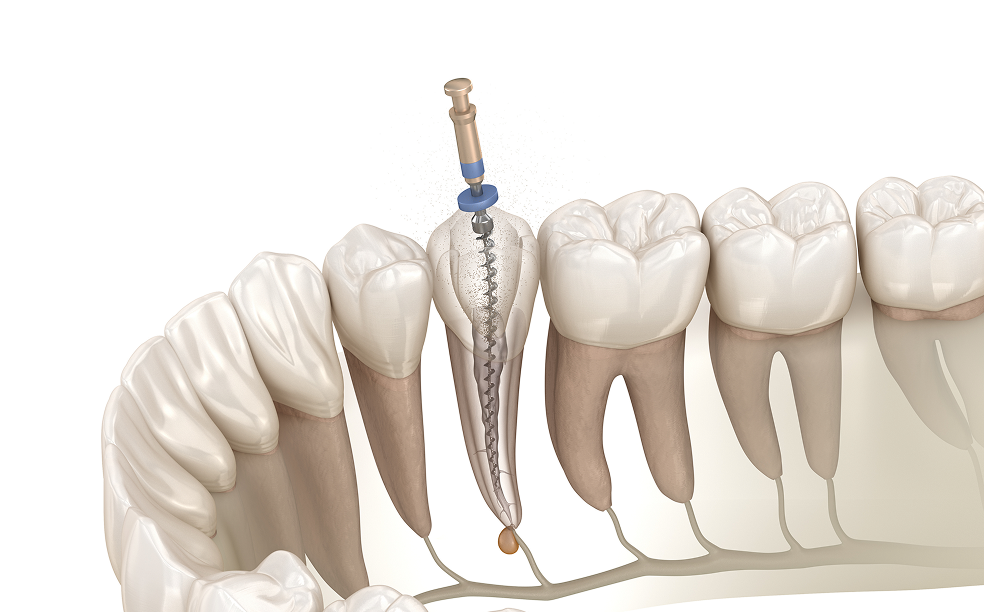 根管治療の目的