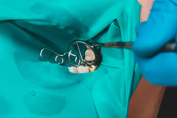 ラバーダムの使用